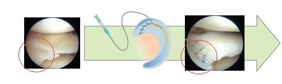 縫合前　生理食塩水で溶解したシルクエラスチンを、縫合部位に留置する説明画像
